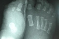 meromelia-defecto-longitudinal-pre-y-post-axial-pie-izq-1985-000