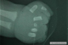 meromelia-defecto-transversal-terminal-mano-izq-1991-000