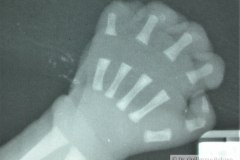 meromelia-defecto-transversal-terminal-mano-izq-000
