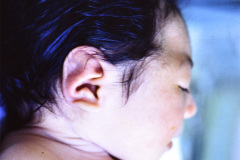 microcefalia-004