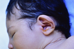 microcefalia-005
