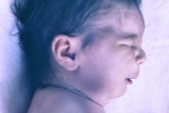 microftalmia-der-cardiopatia-cianogena-1990-001