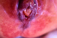 micromielia-mar-fistula-rectovestibular-1986-009
