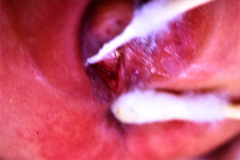 micromielia-mar-fistula-rectovestibular-1986-011