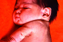 micromielia-mar-fistula-rectovestibular-1986-015