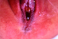 micromielia-mar-fistula-rectovestibular-1986-018