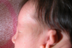 microtia-agenesia-conducto-auditivo-externo-cae-bil-2010-006