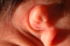 microtia-agenesia-conducto-auditivo-externo-cae-bil-2010-008
