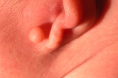 microtia-agenesia-conducto-auditivo-externo-cae-bil-2010-009
