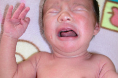 microtia-agenesia-conducto-auditivo-externo-cae-bil-2010-014