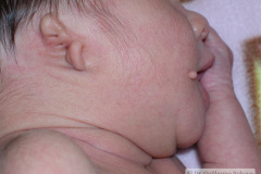 microtia-agenesia-conducto-auditivo-externo-cae-bil-2010-017