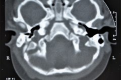 microtia-bil-sin-agenesia-conducto-auditivo-externo-acae-tac-1995-020