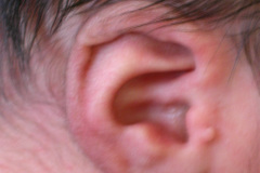 microtia-der-agenesia-concucto-auditivo-externo-cae-2009-000