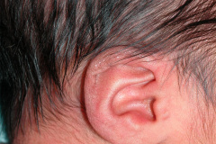 microtia-der-agenesia-concucto-auditivo-externo-cae-2009-001