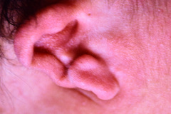 microtia-der-agenesia-concucto-auditivo-externo-cae-fistula-preauricular-apendice-preauricular-izq-000