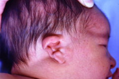 microtia-der-agenesia-concucto-auditivo-externo-cae-fistula-preauricular-apendice-preauricular-izq-001
