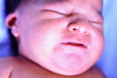 microtia-der-agenesia-concucto-auditivo-externo-cae-fistula-preauricular-apendice-preauricular-izq-003