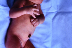 microtia-der-agenesia-concucto-auditivo-externo-cae-000