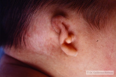 microtia-der-agenesia-concucto-auditivo-externo-cae-003