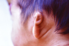 microtia-izq-agenesia-concucto-auditivo-externo-cae-2000-001