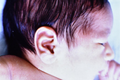 microtia-izq-agenesia-concucto-auditivo-externo-cae-001