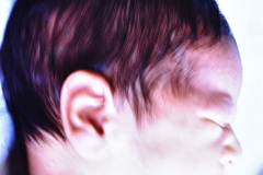 microtia-izq-agenesia-concucto-auditivo-externo-cae-003