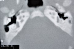 microtia-y-agenesia-conducto-auditivo-externo-acae-bil-tac-1996-005