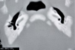 microtia-y-agenesia-conducto-auditivo-externo-acae-bil-tac-1996-016