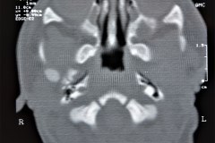 microtia-y-agenesia-conducto-auditivo-externo-acae-bil-tac-1998-000
