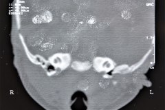 microtia-y-agenesia-conducto-auditivo-externo-acae-bil-tac-1998-001