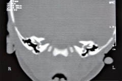 microtia-y-agenesia-conducto-auditivo-externo-acae-bil-tac-1998-006