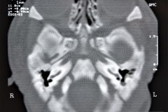 microtia-y-agenesia-conducto-auditivo-externo-acae-bil-tac-1998-010