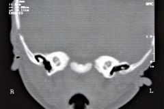 microtia-y-agenesia-conducto-auditivo-externo-acae-bil-tac-1998-012