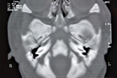 microtia-y-agenesia-conducto-auditivo-externo-acae-bil-tac-1998-013