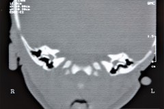 microtia-y-agenesia-conducto-auditivo-externo-acae-bil-tac-1998-018