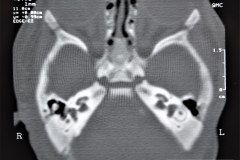 microtia-y-agenesia-conducto-auditivo-externo-acae-bil-tac-1998-021