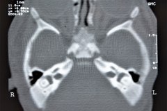 microtia-y-agenesia-conducto-auditivo-externo-acae-bil-tac-1998-022