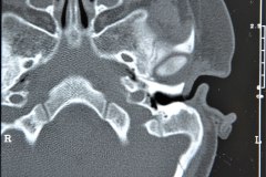 microtia-y-agenesia-conducto-auditivo-externo-acae-der-tac-1995-011