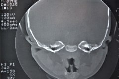 microtia-y-agenesia-conducto-auditivo-externo-acae-izq-tac-1998-000