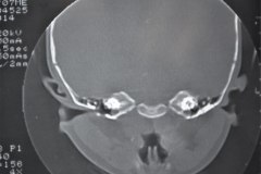 microtia-y-agenesia-conducto-auditivo-externo-acae-izq-tac-1998-001