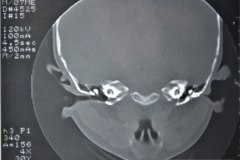 microtia-y-agenesia-conducto-auditivo-externo-acae-izq-tac-1998-003
