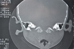 microtia-y-agenesia-conducto-auditivo-externo-acae-izq-tac-1998-004