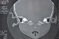 microtia-y-agenesia-conducto-auditivo-externo-acae-izq-tac-1998-005