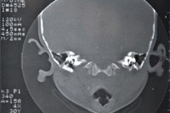 microtia-y-agenesia-conducto-auditivo-externo-acae-izq-tac-1998-007