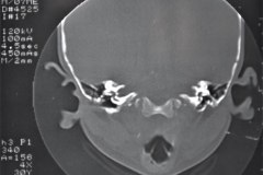 microtia-y-agenesia-conducto-auditivo-externo-acae-izq-tac-1998-008