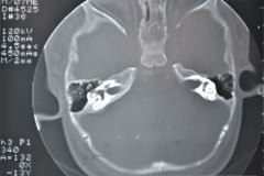 microtia-y-agenesia-conducto-auditivo-externo-acae-izq-tac-1998-009