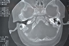 microtia-y-agenesia-conducto-auditivo-externo-acae-izq-tac-1998-010