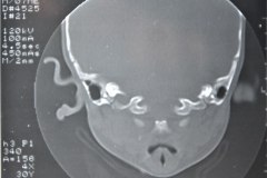 microtia-y-agenesia-conducto-auditivo-externo-acae-izq-tac-1998-012