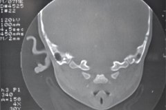 microtia-y-agenesia-conducto-auditivo-externo-acae-izq-tac-1998-013