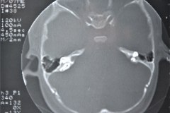microtia-y-agenesia-conducto-auditivo-externo-acae-izq-tac-1998-015